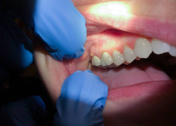 Best Emergency Treatment for Dental Infections or Abscesses in Pine Bluff, AR
